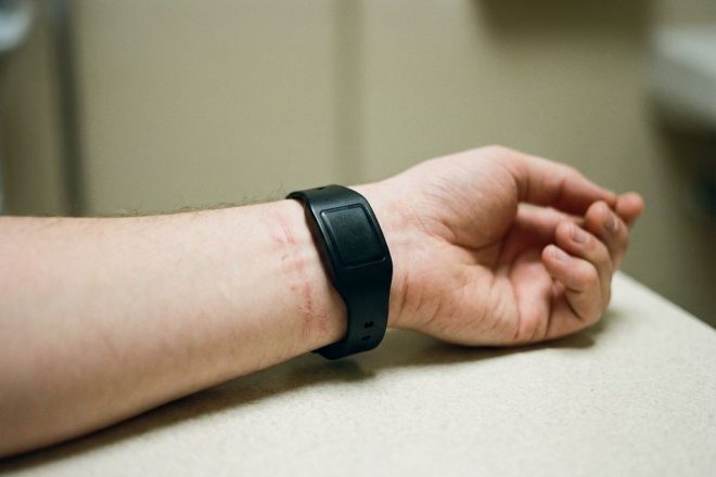 Pols met zwarte RFID-polsband die te strak zit, rode irritatie en indrukken zichtbaar op de huid